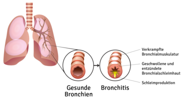 Eine erkrankte Lunge (Bronchitis) Hier sieht man wie die Bronchien verschleimt sind, wenn man an einer Erkältung leidet. © Seezer33 / shutterstock.com
