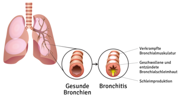 Hier sieht man wie die Bronchien verschleimt sind, wenn man an einer Erkältung leidet. © Seezer33 / shutterstock.com