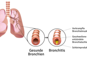 Hier sieht man wie die Bronchien verschleimt sind, wenn man an einer Erkältung leidet.