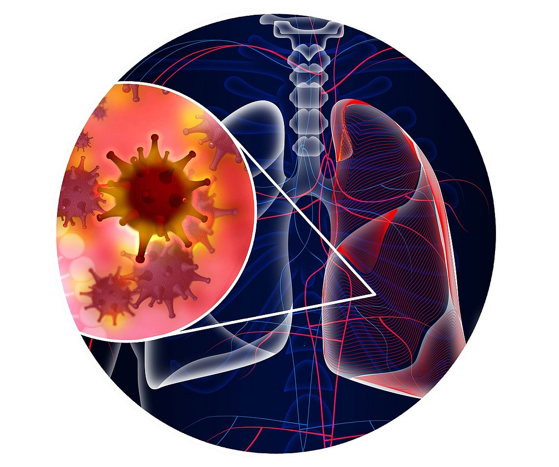Hier sieht man wie die Erkältungsviren (Atemwegsinfekt) sich in der Lunge verbreiten.